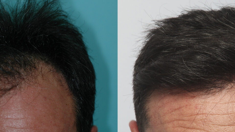 Mediteknia - Casos reales trasplante de pelo