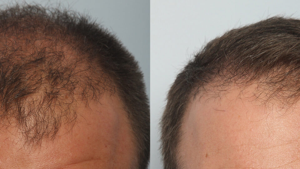 Mediteknia - Casos reales trasplante de pelo