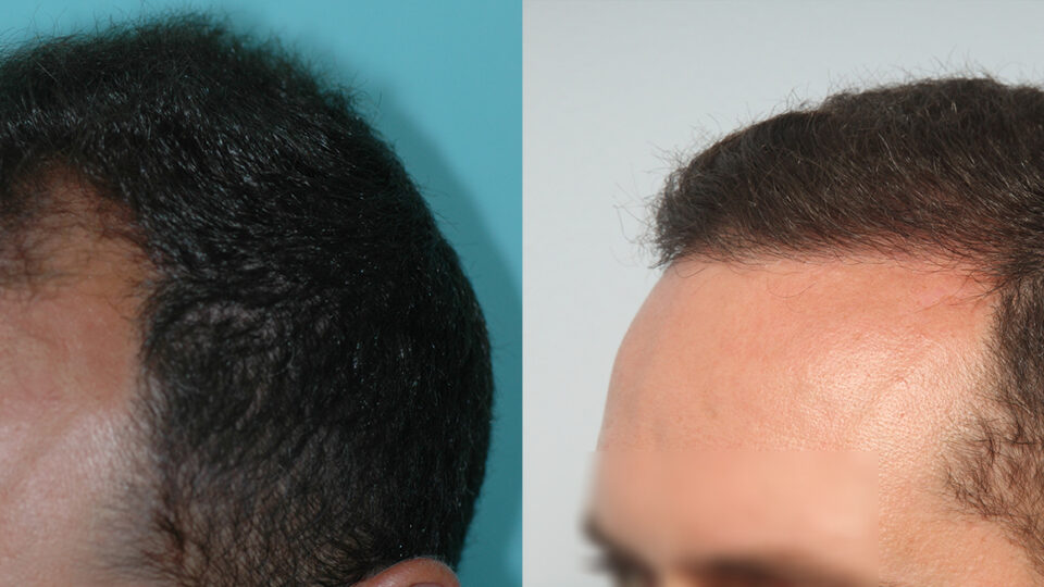 Mediteknia - Casos reales trasplante de pelo