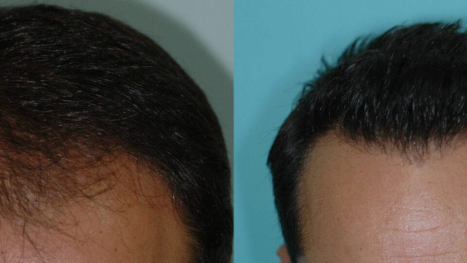 Mediteknia - Casos reales trasplante de pelo