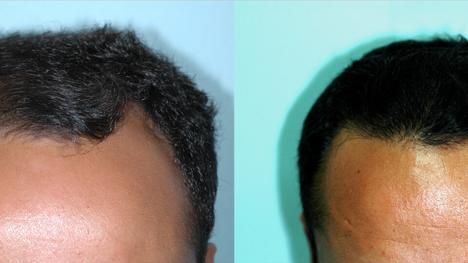 Mediteknia - Casos reales trasplante de pelo