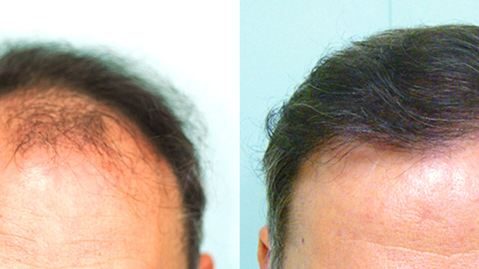 Mediteknia - Casos reales trasplante de pelo