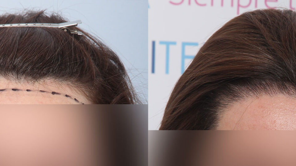 Mediteknia - Casos reales trasplante de pelo