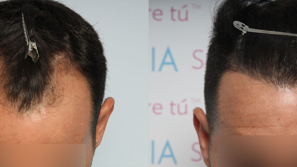 Mediteknia - Casos reales trasplante de pelo