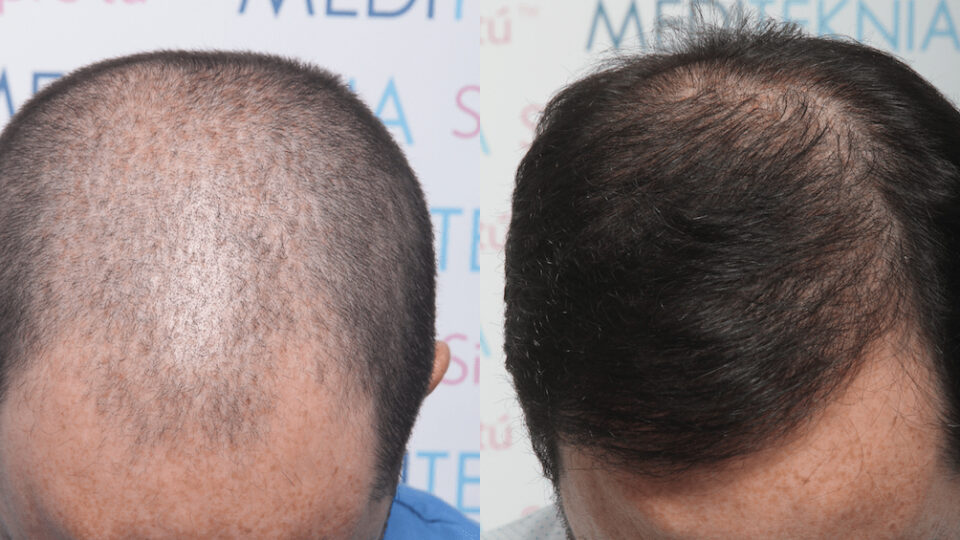 Mediteknia - Casos reales trasplante de pelo