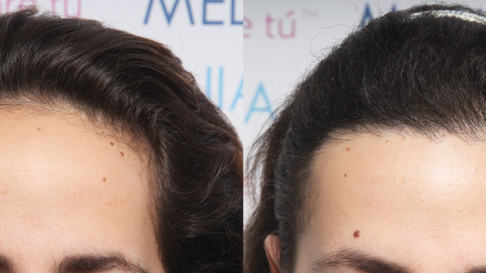 Mediteknia - Casos reales trasplante de pelo