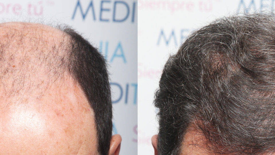 Mediteknia - Casos reales trasplante de pelo