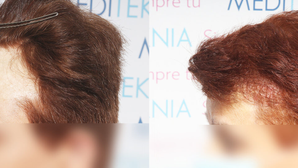 Mediteknia - Casos reales trasplante de pelo